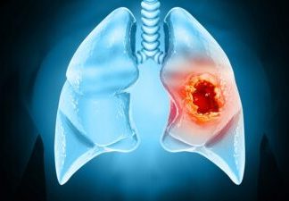 Celulele canceroase își modifică mediul înconjurător pentru a forma tumori 0 (0)