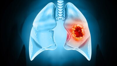 Lung-cancer-tumor-400x225