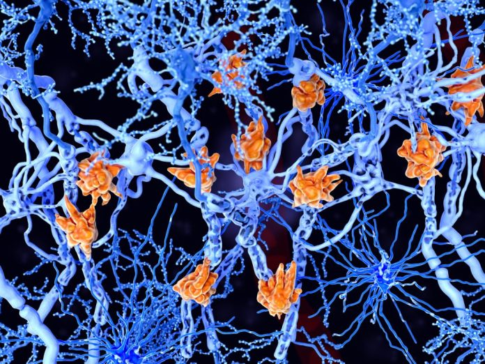 Multiple-Sclerosis-1141952174-copy-1024x768