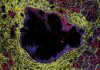 Leziunile precanceroase pancreatice nu duc întotdeauna la cancer