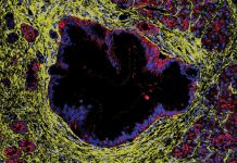 Leziunile precanceroase pancreatice nu duc întotdeauna la cancer