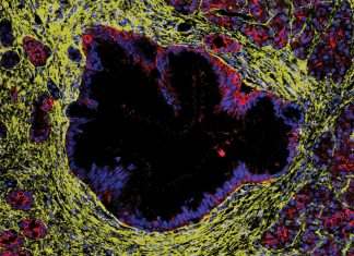 Leziunile precanceroase pancreatice nu duc întotdeauna la cancer 0 (0)
