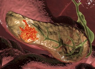 Inovație în Oncologia Pancreatică: Modelul „Tumoră-pe-cip” Derivat de la Pacient Îmbunătățește Studiul Cancerului Pancreatic 0 (0)