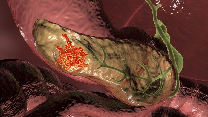 Pancreatic-Cancer-1215121154
