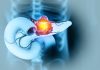 Un nou medicament pentru cancerul pancreatic dublează speranța de viață și reduce efectele secundare