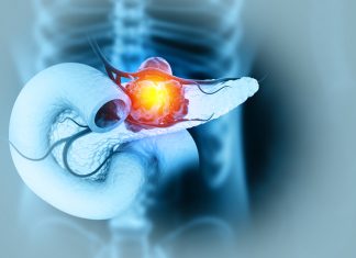 Un nou medicament pentru cancerul pancreatic dublează speranța de viață și reduce efectele secundare 0 (0)