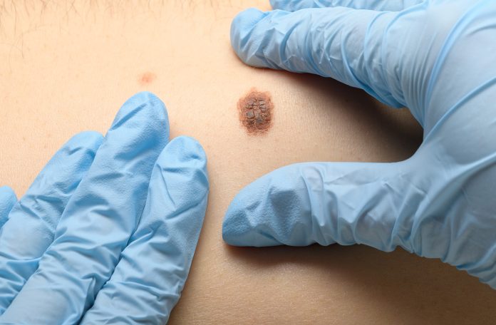 Getty_1217156782_SkinCancer_Mole
