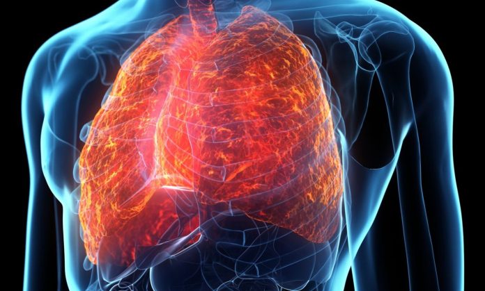 Lung-disease-1190667851-e1780079341804