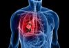 Impactul mutării BRAF asupra rezultatelor în cancerul pulmonar cu celule non-Mici