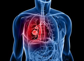 Impactul mutării BRAF asupra rezultatelor în cancerul pulmonar cu celule non-Mici 0 (0)