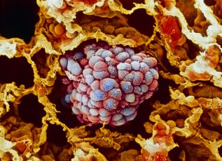 Sistemul AI depășește PD-L1 în prezicerea rezultatelor imunoterapiei în cancerul pulmonar 0 (0)