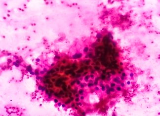 Celule gigant-nucleu asociate cu cancerul în stadiu incipient și rezistența la feroptoză 0 (0)