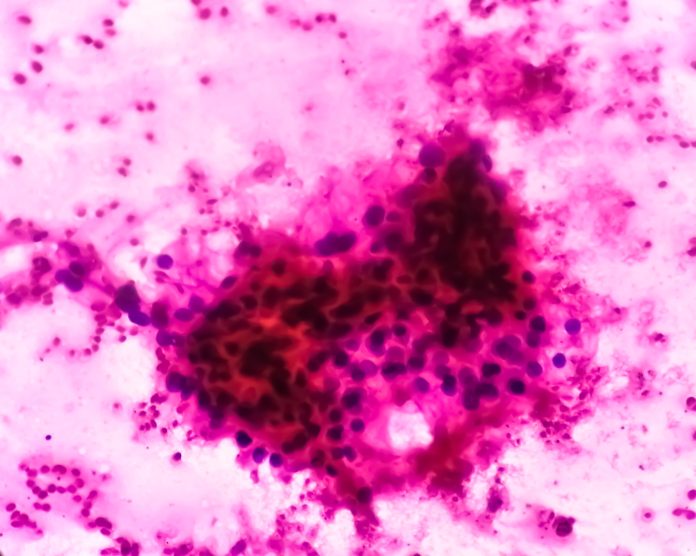 Kidney-Cancer-1393519348