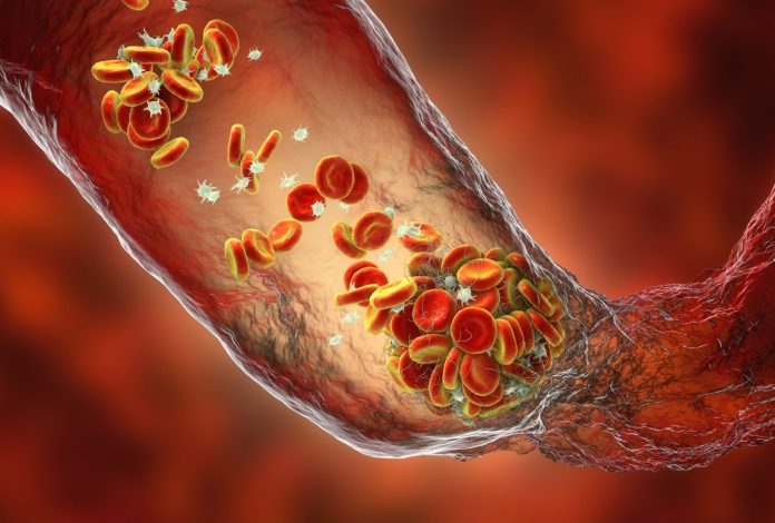 Thrombosis-1332098839-e1673367186578