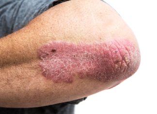 Un nou jucător în psoriazis: proteina CHI3L2 ar putea schimba tratamentul bolii 5 (1)