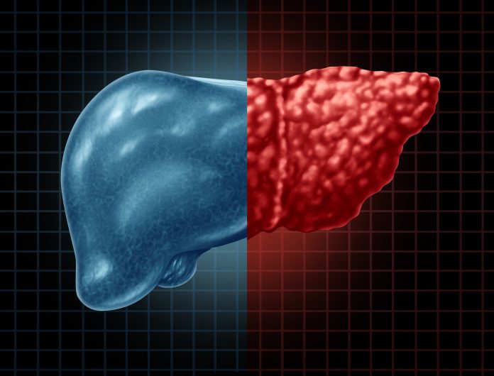 Fatty-Liver-1030711158