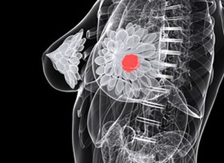 De ce femeile tinere și cele cu venituri mici ajung mai târziu la tratament în cancerul de sân 0 (0)