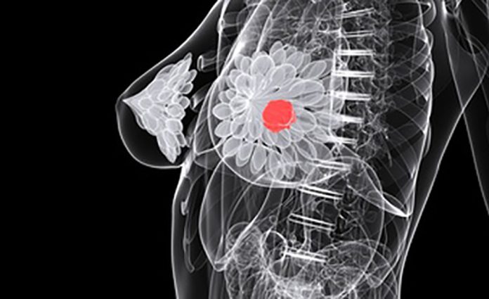 Fotolia_21425225_BreastCancerBlackWhiteIllustration