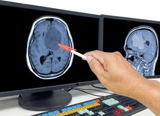 Terapia combinată deschide noi speranțe în tratarea glioblastomului 0 (0)