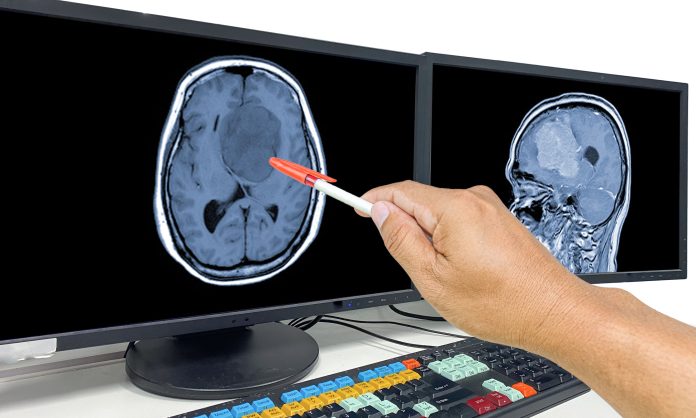 Glioblastoma-1439470025