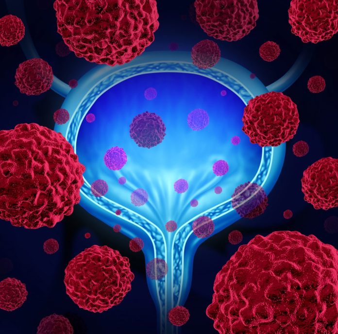 bladder-cancer-546435356-1024x1012